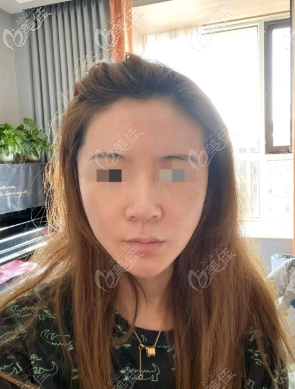 輪廓手術后面部下垂了，在韓國歌娜做了面部拉皮手術