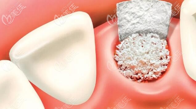 種植牙植骨粉 種植牙植骨粉