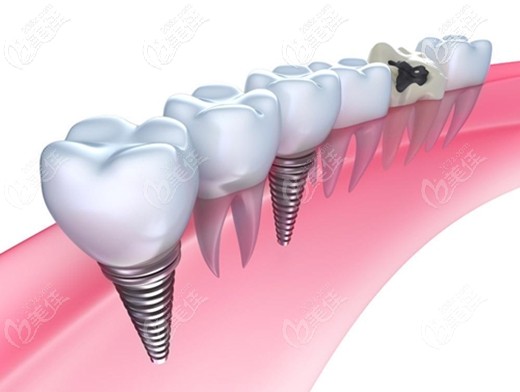 陳青龍醫(yī)生科普不同品牌種植體的特色 陳青龍醫(yī)生科普不同品牌種植體的特色