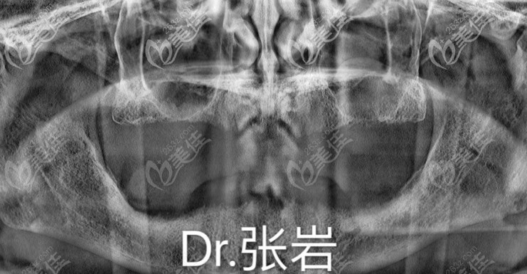 滿口牙缺失未種植前的CT片 滿口牙缺失未種植前的CT片