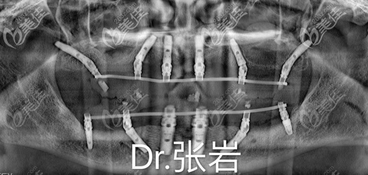 這有60歲老人全口種植上下6顆樁的圖片，滿(mǎn)口做的是登騰allon6種植牙