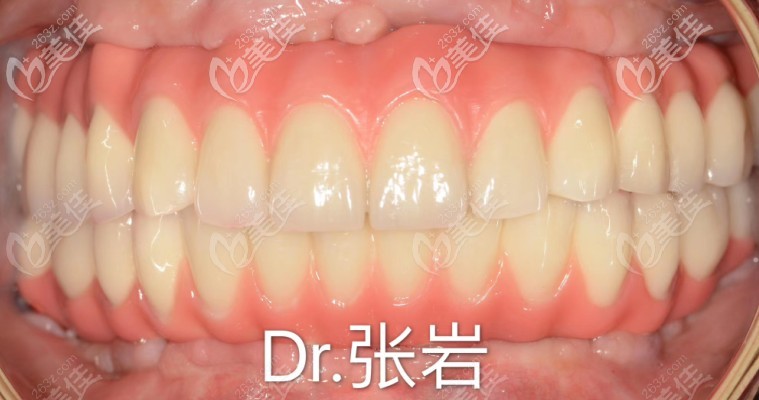 allon6種植牙效果圖 allon6種植牙效果圖