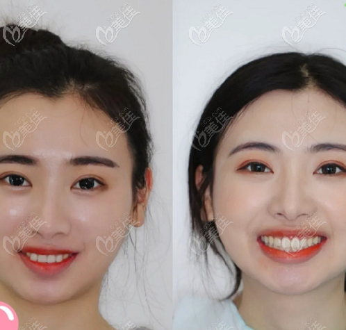 去年三月在北京壹加壹口腔做時(shí)代天使隱形矯正花了16800元,感覺(jué)很靠譜 去年三月在北京壹加壹口腔做時(shí)代天使隱形矯正花了16800元,感覺(jué)很靠譜