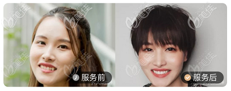 北京壹加壹口腔隱適美隱形牙齒矯正案例