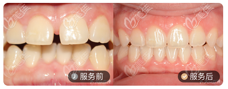 北京壹加壹口腔隱適美隱形矯正案例