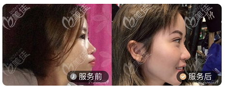 北京壹加壹口腔陶瓷半隱形牙齒矯正案例