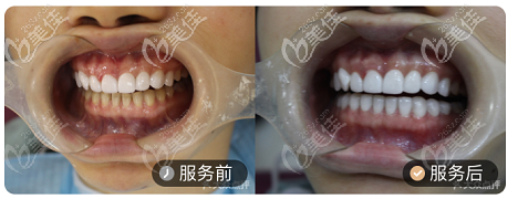 北京壹加壹牙科超薄瓷貼面案例對比圖