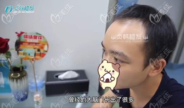 植發(fā)前前額脫發(fā)明顯