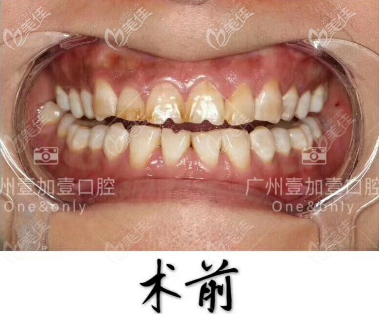 廣州壹加壹口腔美加超薄全瓷貼面案例 廣州壹加壹口腔美加超薄全瓷貼面案例