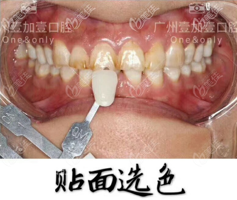 美加超薄牙貼面選色照片 美加超薄牙貼面選色照片