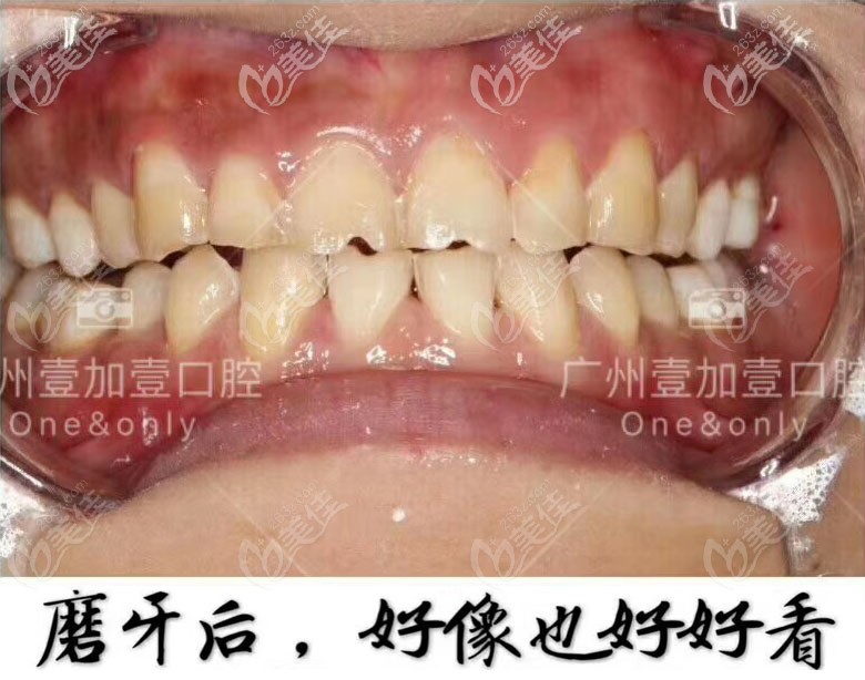 牙齒貼面磨牙后圖片 牙齒貼面磨牙后圖片