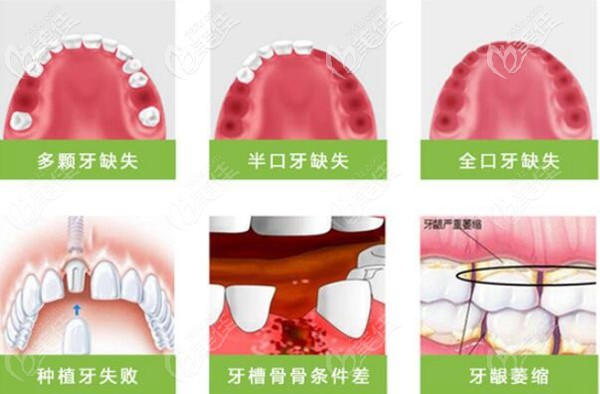種植牙適合的種植人群
