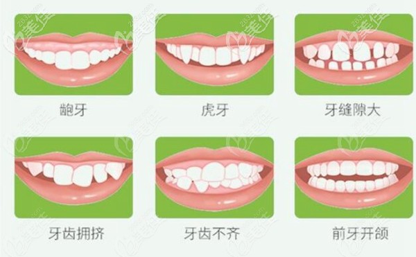 適合做隱形矯正的人群 適合做隱形矯正的人群