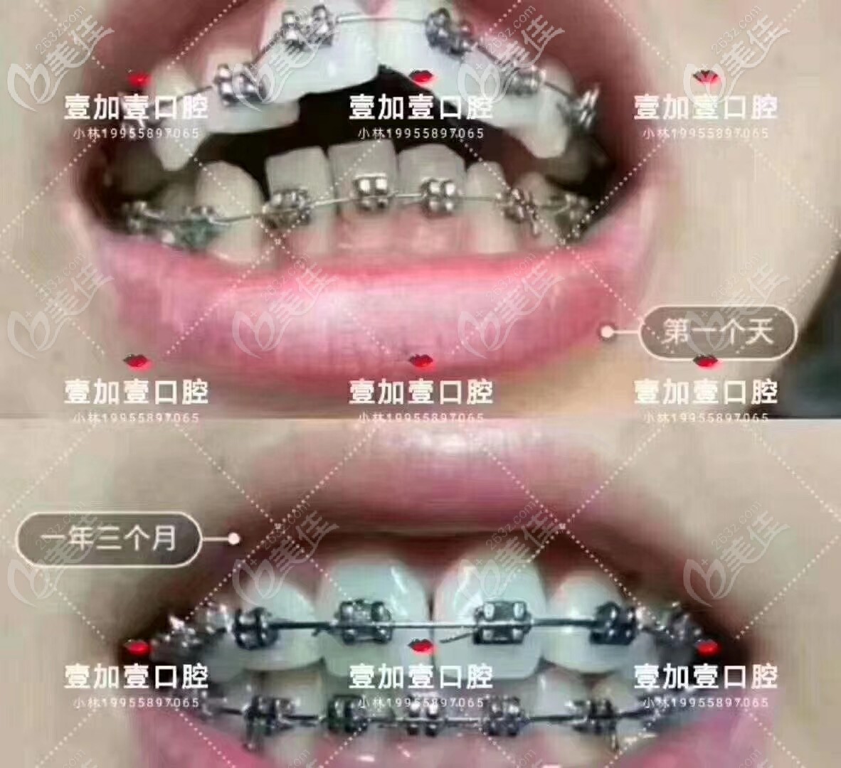 真人案例了解廣州壹加壹金屬托槽矯正怎么樣？