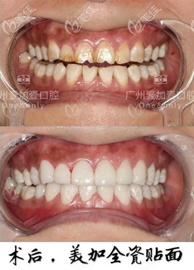 廣州壹加壹美加全瓷牙貼面案例對(duì)比圖