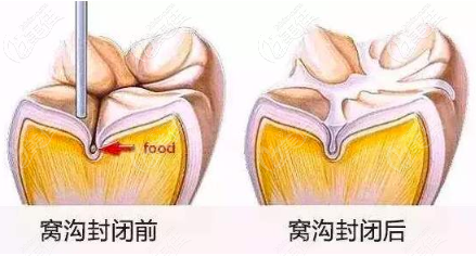 窩溝封閉治療前后對(duì)比