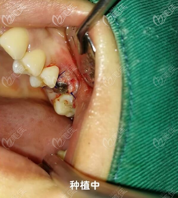 做瑞士ITI種植牙手術(shù)中