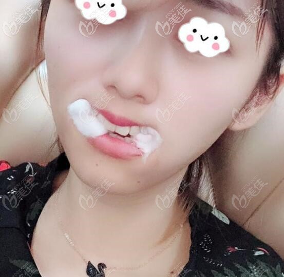 牙齒矯正要拔牙4顆