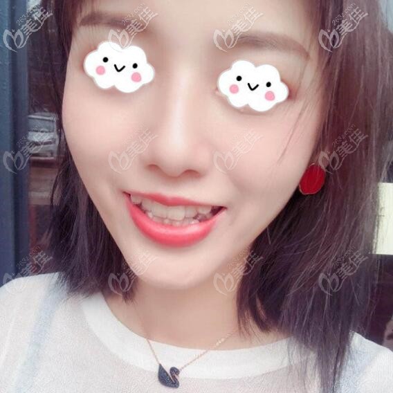 在廣州壹加壹做隱適美矯正價格4萬多