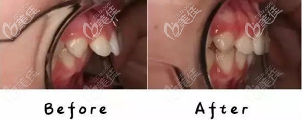 在深圳光美口腔做隱形矯正一年效果