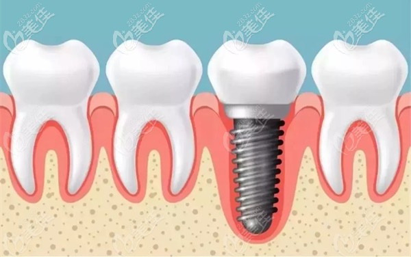 寮步莞大口腔的美國皓圣種植牙參考價(jià)格