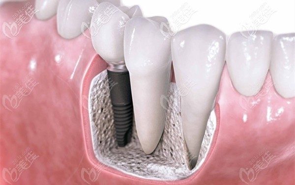 東莞莞大口腔的瑞士ITI種植牙參考價(jià)格