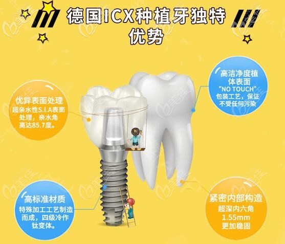 德國icx進口品牌種植牙優(yōu)勢 德國icx進口品牌種植牙優(yōu)勢