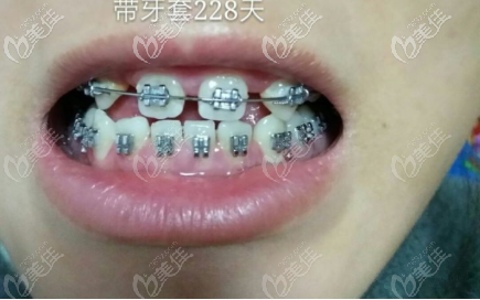 已經(jīng)戴牙套二百多天了