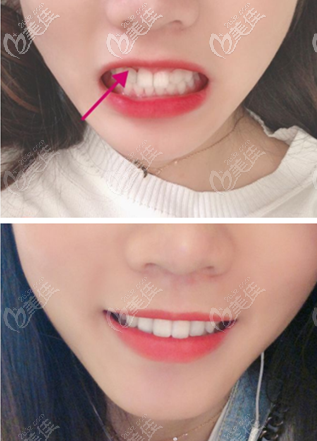 知道瑞士ITI親水種植體1萬5一顆不便宜，但我太怕沒牙了