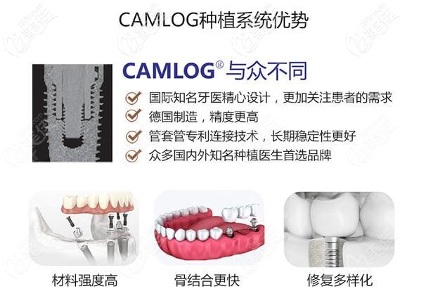 德國(guó)camlog種植牙優(yōu)勢(shì) 德國(guó)camlog種植牙優(yōu)勢(shì)
