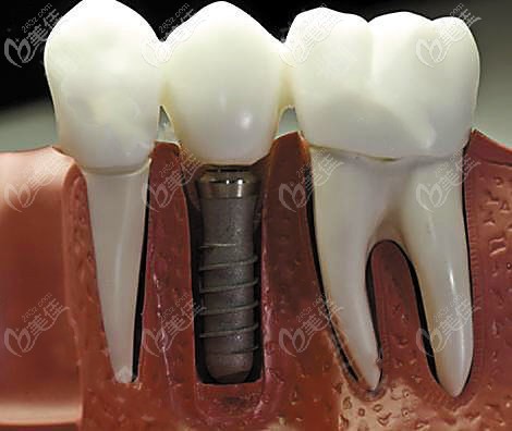 做德國(guó)camlog種植體操作示意圖 做德國(guó)camlog種植體操作示意圖