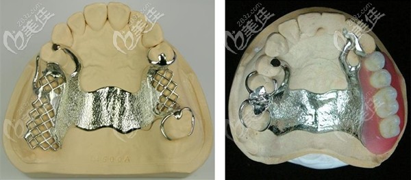 活動牙支架示意圖 活動牙支架示意圖