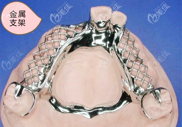 活動(dòng)義齒的金屬支架圖 活動(dòng)義齒的金屬支架圖