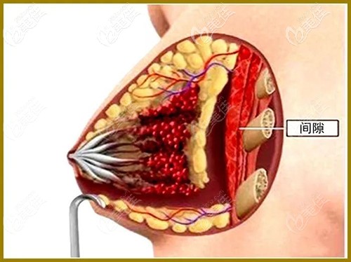 乳暈切口的位置
