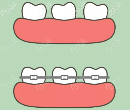 兒童地包天矯正帶牙套示意圖