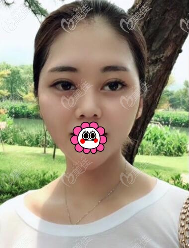 寧波做眼睛哪個醫(yī)院好？來了解一下寧波尚麗做的雙眼皮效果怎么樣