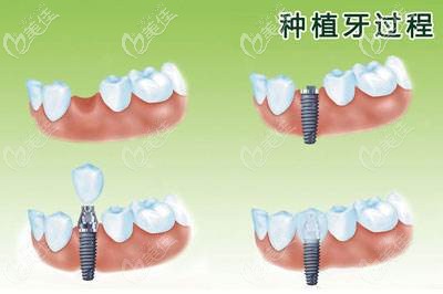 種植牙的過程