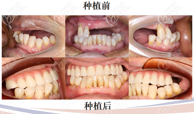 種植前后對比照片