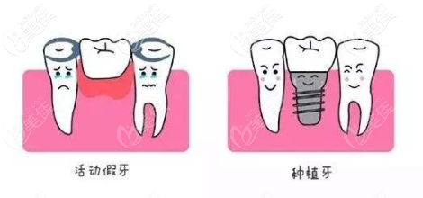 活動假牙和種植牙還是有差別的