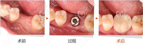 去年在深圳光美口腔做了一顆瑞士ITI種植牙，真心覺(jué)得選擇好植體就是不一樣