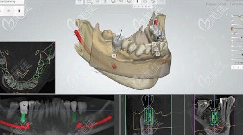 采集數(shù)據(jù)設計種植牙導板