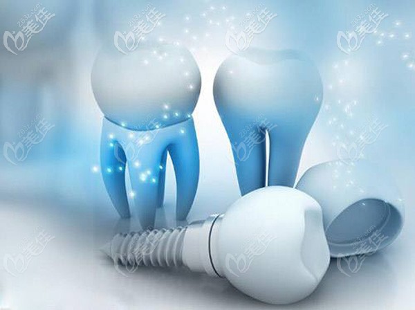 怎么選擇種植牙 怎么選擇種植牙