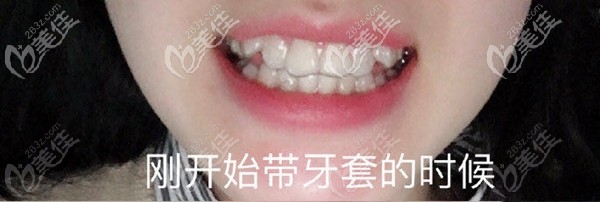 做隱形牙套矯正術前照 做隱形牙套矯正術前照
