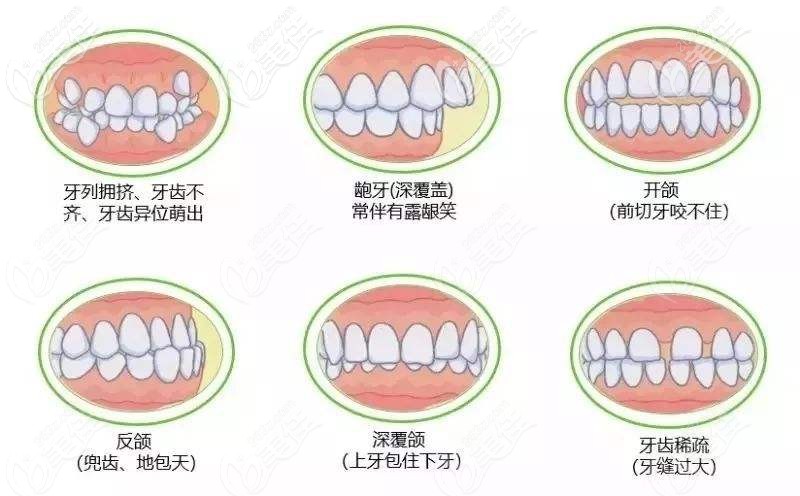 牙齒不齊的危害