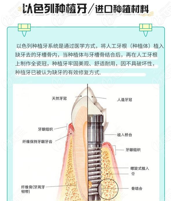 以色列種植牙怎么樣 以色列種植牙怎么樣