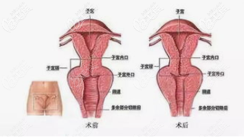 韓國Qline女性醫(yī)院金哉勛陰道緊縮手術(shù)效果圖 韓國Qline女性醫(yī)院金哉勛陰道緊縮手術(shù)效果圖