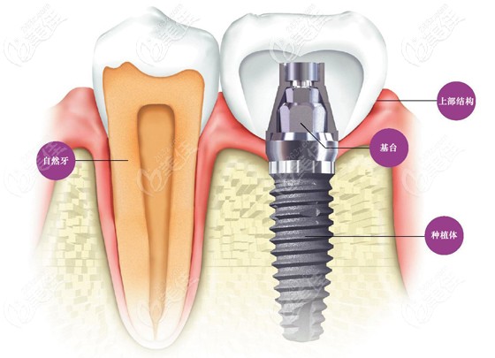 以色列和瑞士種植體哪個好 以色列和瑞士種植體哪個好