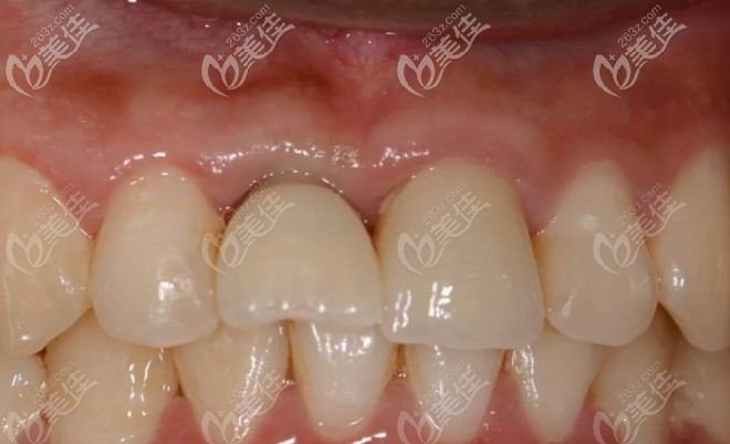 當(dāng)天種植戴入臨時牙效果圖 當(dāng)天種植戴入臨時牙效果圖