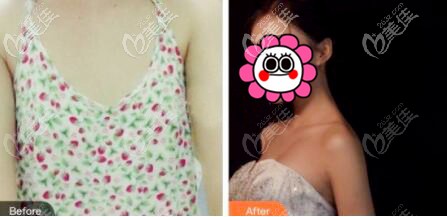 <!--<i data=20240703-sp></i>-->假體隆胸對(duì)比效果圖 <!--<i data=20240703-sp></i>-->假體隆胸對(duì)比效果圖