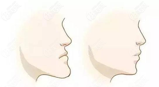 朱彩寅醫(yī)生淺談牙齒矯正能改變臉型嗎 朱彩寅醫(yī)生淺談牙齒矯正能改變臉型嗎